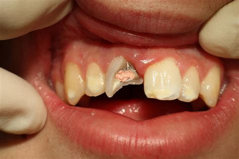 Chipped Tooth Or Broken Tooth Glow Dental Provide A Resolution For You