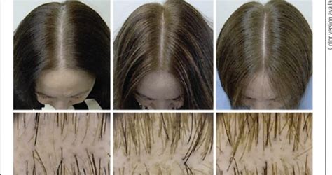 Top 48 Image Does Spironolactone Cause Hair Loss Vn