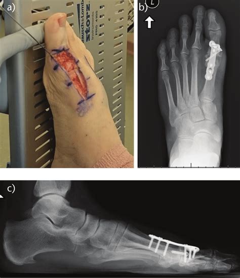 Metatarsophalangeal Mtp Arthrodesis A Clinical Evaluation Of Mtp