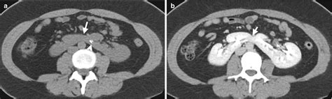 Normal Variant And Congenital Anomalies Radiology Key