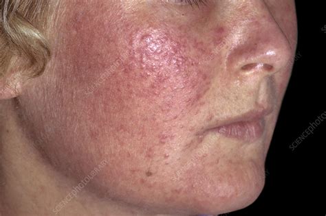 Acne Rosacea Stock Image C0384495 Science Photo Library