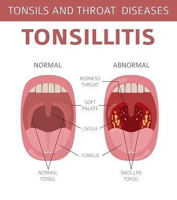 Signs Of Tonsillitis
