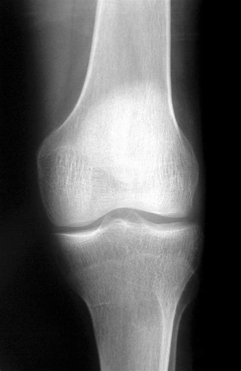 Knee X Ray 1 Free Stock Photo Freeimages