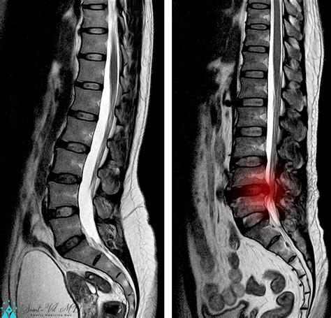 Mri Lumbar Spine Scan Sagittal View Lumbosacral Spine Has Straightening