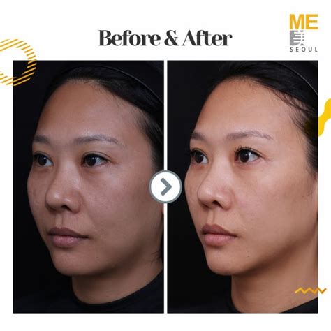 Trusculpt Before And After Photos Blog Me Clinic Seoul