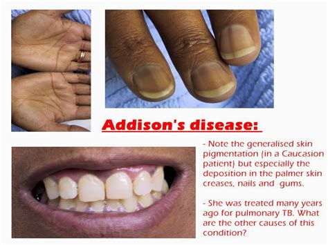 Medical Treatment Pictures For Better Understanding Addisons Disease