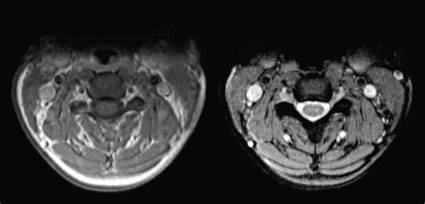 Normal Cervical Spine Axial Mri Hot Sex Picture