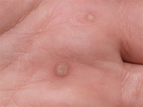 Warts And Molluscum — Fisher Dermatology And Aesthetics