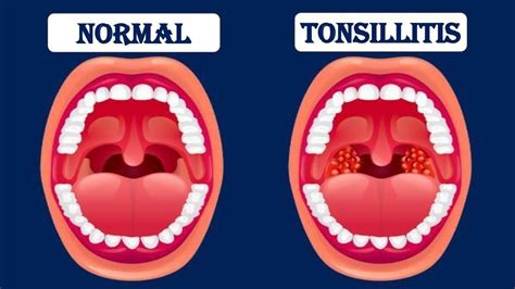 Tonsillitis टॉन्सिल्स में सूजन का घरेलू उपचार In Hindi Youtube
