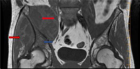 Mri Of The Pelvis And Lumbar Spine With And Without Contrast Revealed A