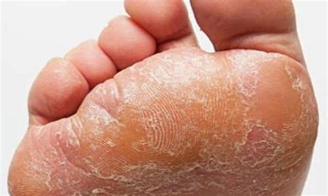 Athletes Foot Complications Treatment And Look Like Wiki Itchy Mind