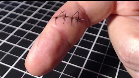 Removing Finger Stitches Youtube