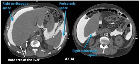 Figure 15 From Peritoneal Cavity Anatomy In Ct Peritoneography A