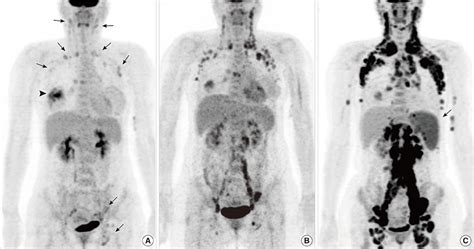 Concurrent Invasive Ductal Carcinoma Of The Breast And Malignant