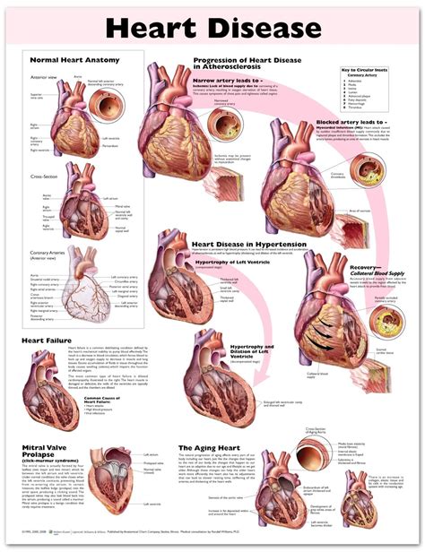 Heart Disease Chart Poster Laminated Cardiología Anatomía Y