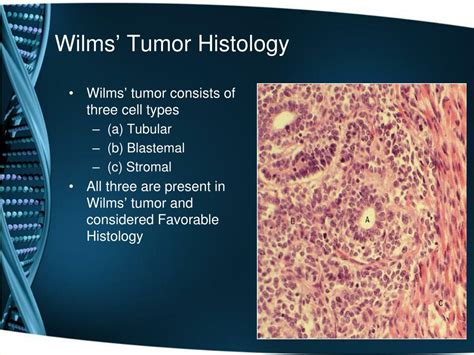 Ppt Pediatric Abdominal Tumors A Focus On Wilms Tumor Powerpoint