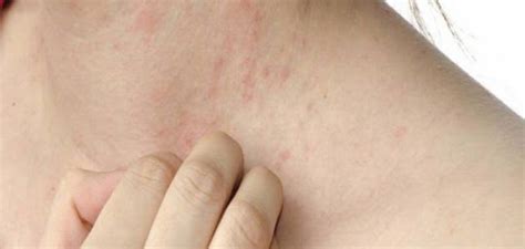 هل مرض الهربس الجلدي معدي