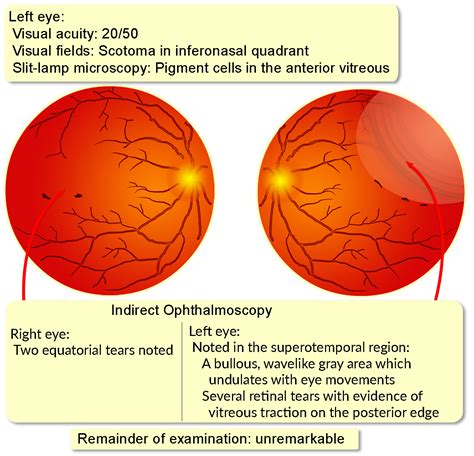 Retinal Detachment Rhegmatogenous Interactive Case Study Clinical