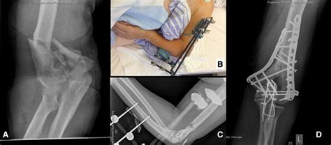 Distal Humerus Fracture Type Ao 13 C3 A Primary External Fixation