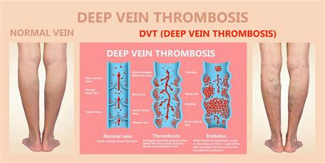 How Do You Know If You Have Deep Vein Thrombosis Dvt