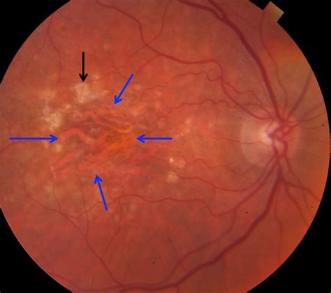 Dry Macular Degeneration With Geographic Retinal Pigment Epithelial
