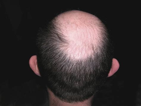 Hair Loss Explained How And Why Men Go Bald The Independent The