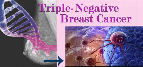 Triple Negative Breast Cancertnbc Hematology And Oncology Cancer