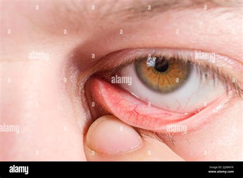 Red Lower Eyelid A Macro Photo Of The Human Eye Conjunctivitis Inflammation Of The Mucous