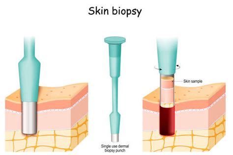 Skin Biopsies What To Expect Thumbay University Hospital