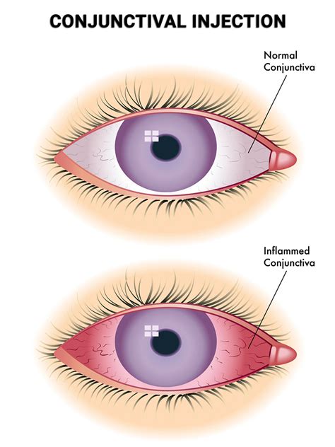 Conjunctival Injection In Nyc Vitreous Retina Macula Consultants Of