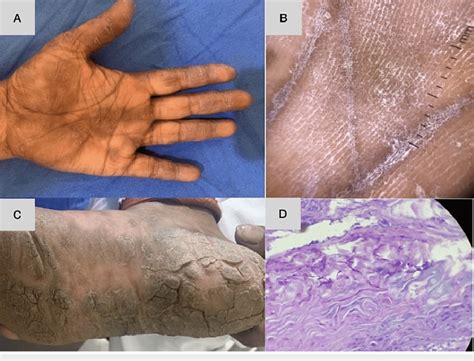 A Case Of Tinea Manuum And Tinea Pedis Showing Involvement Of One Hand