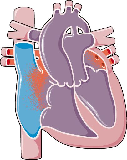 Congenital Heart Disease Transposition Of Great Arteries Servier