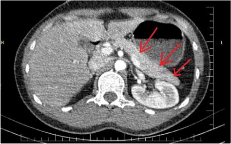 Axial Abdominal Ct Scan With Iv Contrast At Pancreatic Level Shows