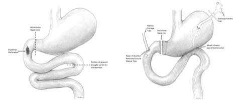 Delayed Presentation Of A Duodenal Perforation After Blunt Abdominal