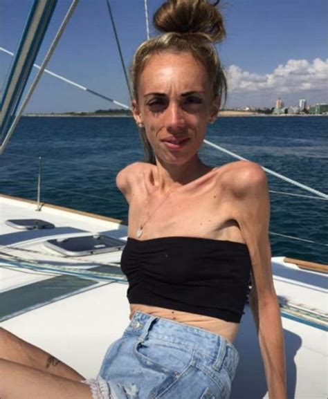 Anorexia Survivor Who Weighed Just 4st Shares Inspiring Recovery Story Metro News