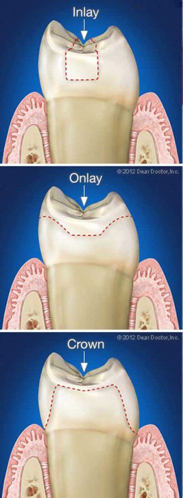 Inlays And Onlays Alexander Drive Dental Clinic Call 08 9276 1540