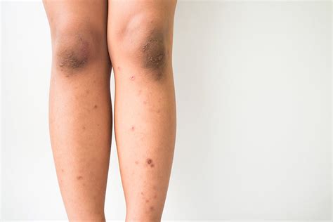 Heres How To Treat Dark Spots On Legs Urban Skin Rx