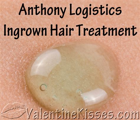 For this home remedy for treating deep ingrown hair, make a concentrated solution of baking soda and water. Valentine Kisses: Anthony Logistics Ingrown Hair Treatment