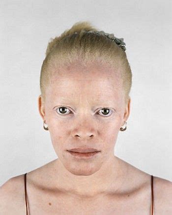 Pin On Albinos