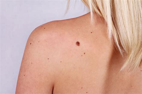 How To Check Cancerous Moles For Skin Cancer Zo Skin Health
