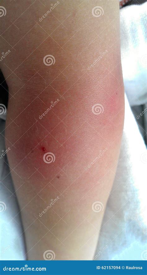 Swollen Arm Stock Photos Royalty Free Pictures
