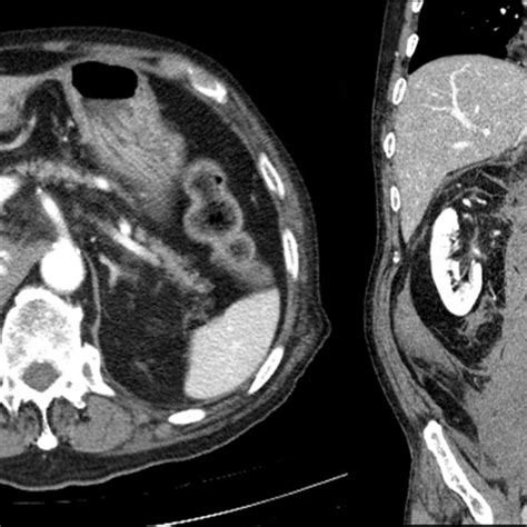 Initial Contrast Enhanced Abdominal Ct Scan Showing Contrast Medium