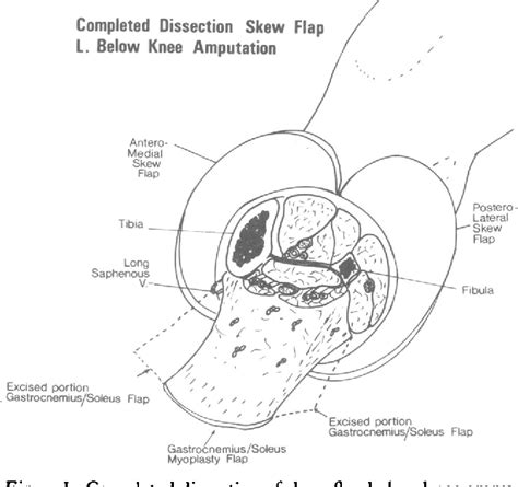 Figure 1 From Skew Flap Below Knee Amputation Semantic Scholar
