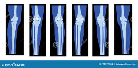 Human Leg Bone Anatomy Leg Bone Lower Bones Tibia Fibula Femur Thigh Hot Sex Picture