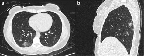 A 30 Year Old Female Presented With Fever And Cough Her Initial Blood