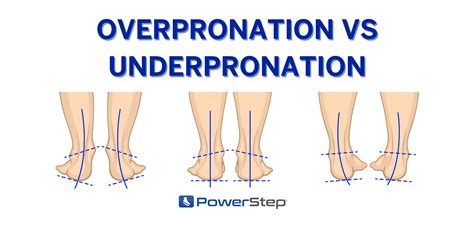 What Is Overpronation Vs Underpronation Powerstep