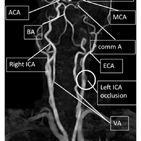MRA Showed An Occluded Carotid Artery 1 Cm From The Origin Arrows