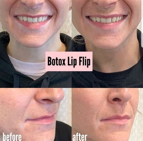 Lip Flip Before And After Smile