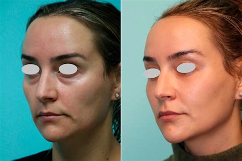 Blepharoplasty Fat Transfer Tear Trough Under Eye Injections Photos