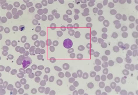 Is This Typical Lymphocyte The Flower Cells